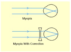 what is hyperopia 