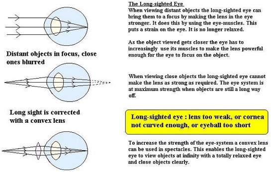 what is hyperopia